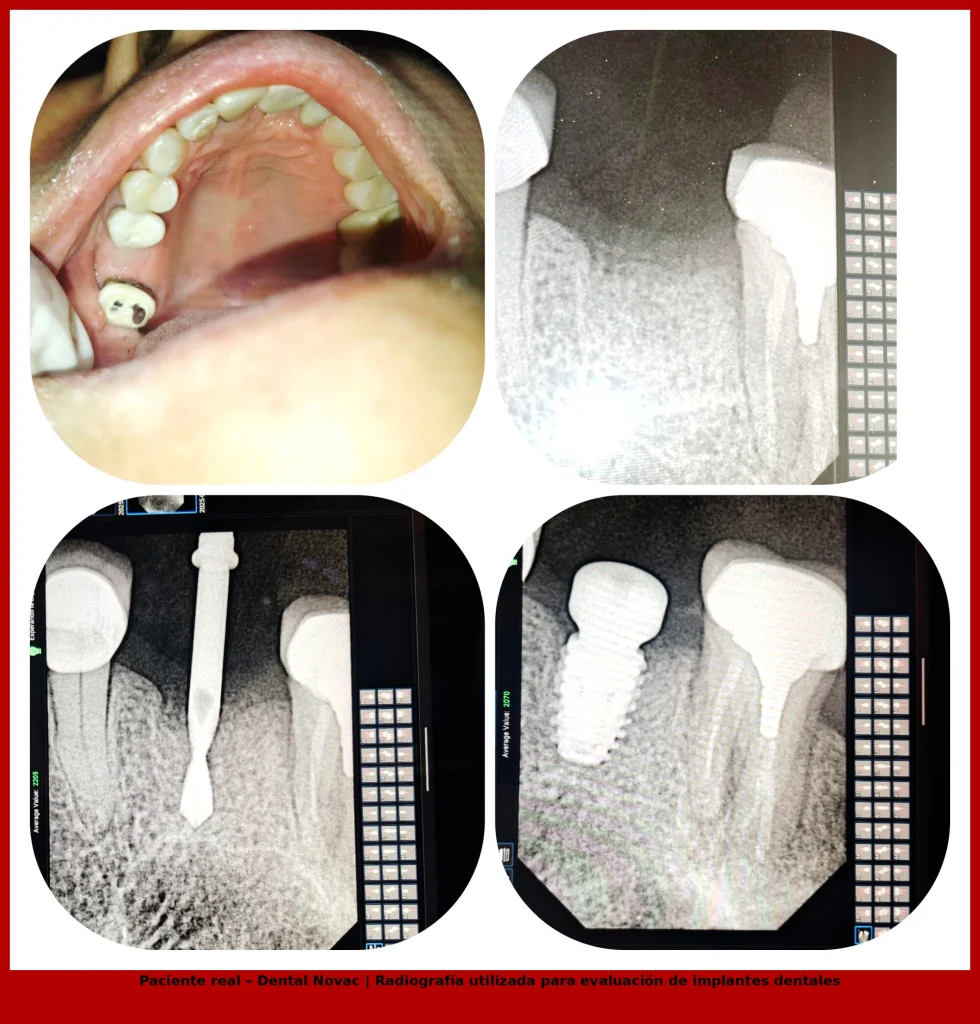 radiografía de implante dental utilizada en tratamiento de salud bucal en clínica Dental Novac